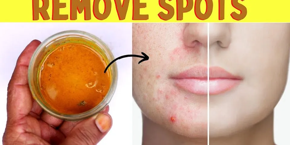 How to remove spots from face in 2 days naturally